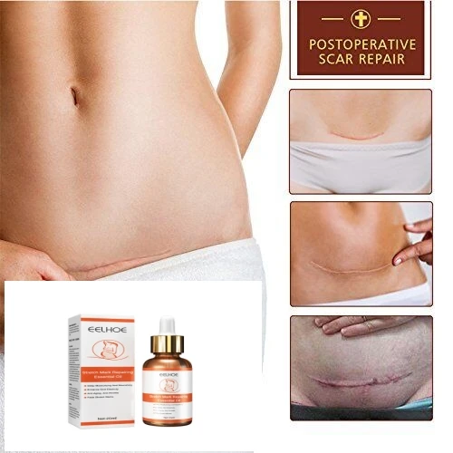 Stretch Marks Remover Essential Oil Skin Care Treatment Cream For Stretch Mark Removal Maternity Slackline For Pregnant Oils
Stretch Marks Remover Essential Oil Skin Care Treatment Cream For Stretch Mark Removal Maternity Slackline For Pregnant Oils