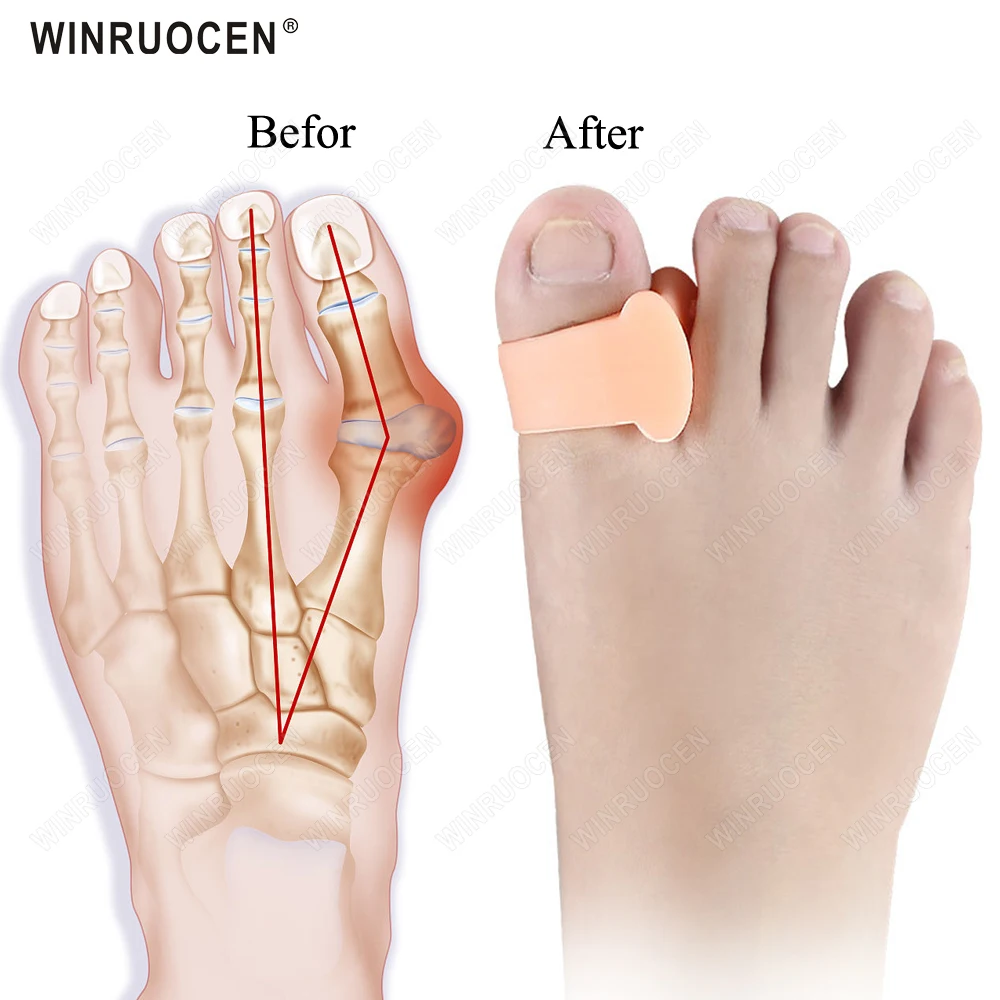 2Pcs=1Pair Silicone Gel Big Toe Separator Bunion Adjuster Foot Fingers Protector Bone Hallux Valgus Corrector Foot Care Pedicure
2Pcs=1Pair Silicone Gel Big Toe Separator Bunion Adjuster Foot Fingers Protector Bone Hallux Valgus Corrector Foot Care Pedicure