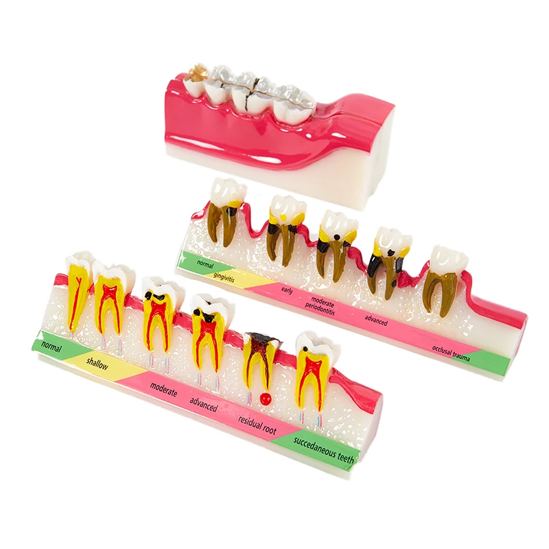 Teeth Model Multiple Types Dental Model Teeth Dental Teaching Models Study Orthodontic Removable Teeth Implant Dentist Material
Teeth Model Multiple Types Dental Model Teeth Dental Teaching Models Study Orthodontic Removable Teeth Implant Dentist Material