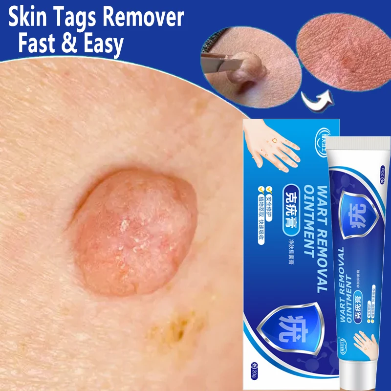 Skin Tag Remover Cream Clean Painless Mole Skin Dark Spot Warts Remover Serum Freckle Face Wart Tag Treatment Essential Oil
Skin Tag Remover Cream Clean Painless Mole Skin Dark Spot Warts Remover Serum Freckle Face Wart Tag Treatment Essential Oil
