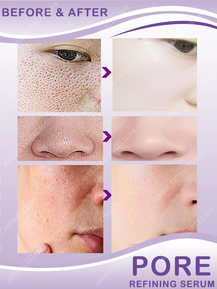 Pore Shrinking Serum Face Removing Large Pores Tightening Repairing Large Pores Facial Pore Minimizing Cream
Pore Shrinking Serum Face Removing Large Pores Tightening Repairing Large Pores Facial Pore Minimizing Cream