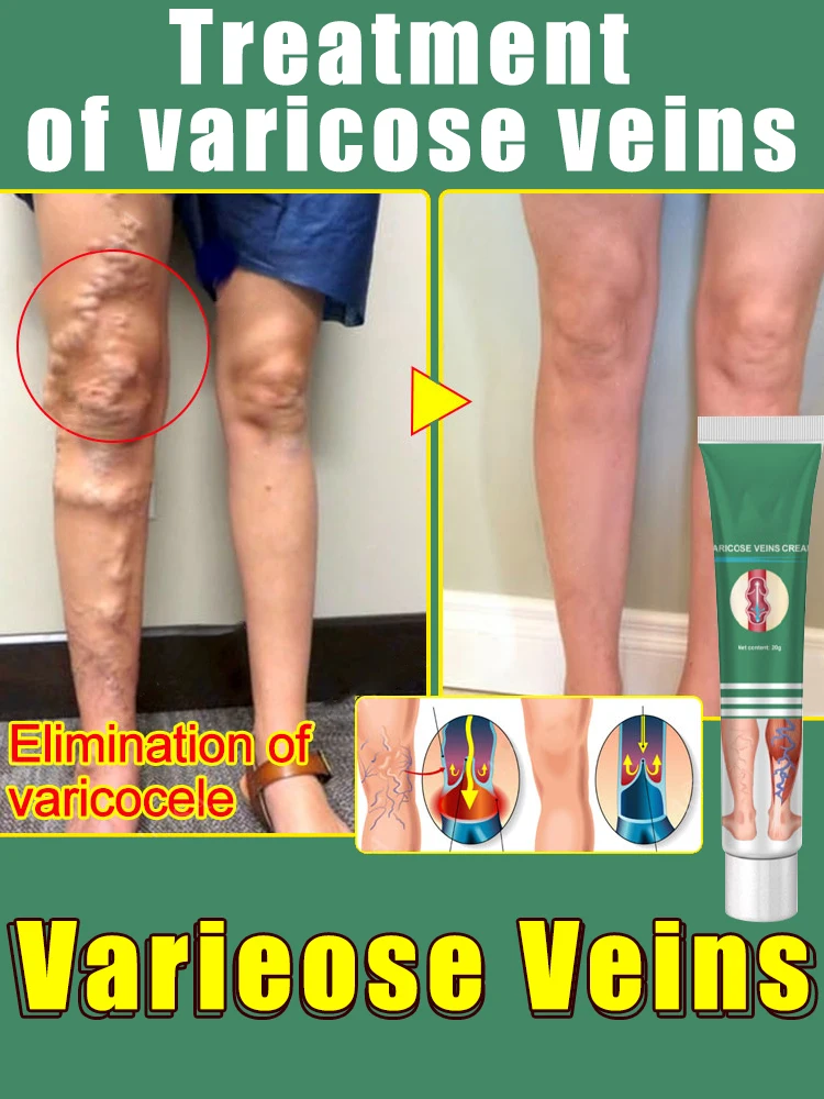 ointment for varicose veins Effective varicose vein relief cream to relieve vasculitis phlebitis spider pain treatment
ointment for varicose veins Effective varicose vein relief cream to relieve vasculitis phlebitis spider pain treatment