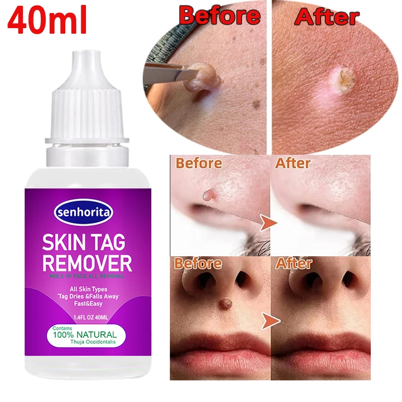 Organic Tags Solutions Serum Painless Mole Skin Dark Spot Remover Serum Freckle Face Wart Tag Removal Essential Oil 40ml
Organic Tags Solutions Serum Painless Mole Skin Dark Spot Remover Serum Freckle Face Wart Tag Removal Essential Oil 40ml