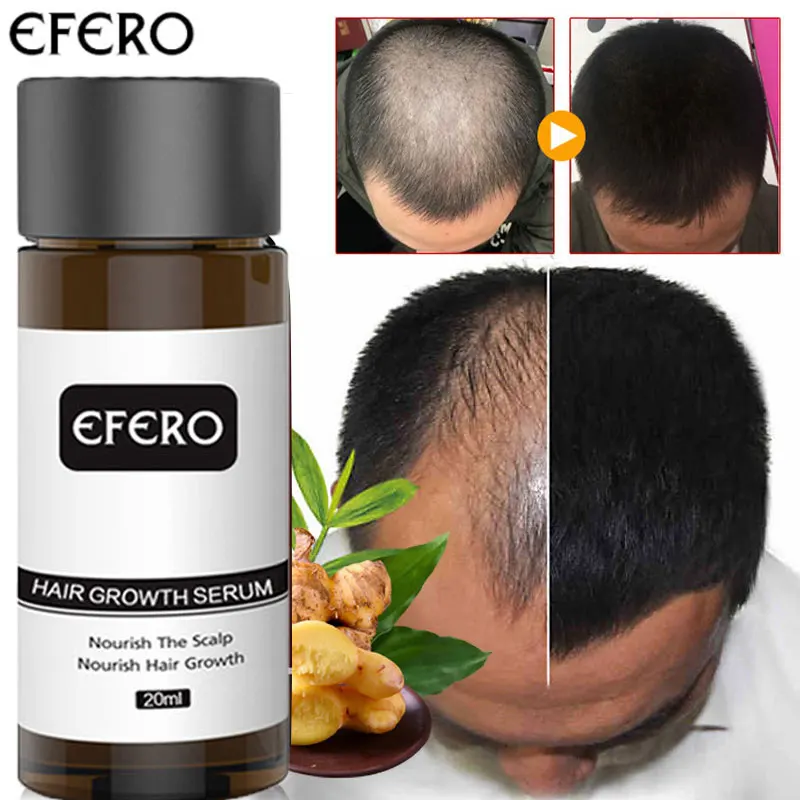 Ginger Hair Growth Products Serum Fast Regrowth Essence Oil Prevent Baldness Hair Loss Care Beauty Scalp Treatment For Men Women
Ginger Hair Growth Products Serum Fast Regrowth Essence Oil Prevent Baldness Hair Loss Care Beauty Scalp Treatment For Men Women