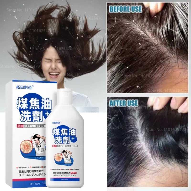 Coal Tar Hair Lotion To Remove Dandruff, Relieve Itching Folliculitis Scalp Acne Mites Oil Control Hair Loss Prevention Shampoo
Coal Tar Hair Lotion To Remove Dandruff, Relieve Itching Folliculitis Scalp Acne Mites Oil Control Hair Loss Prevention Shampoo