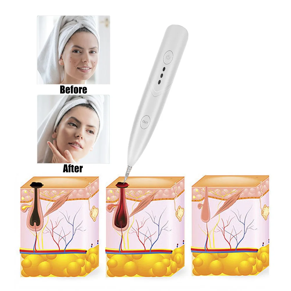 Freckle Remover Machine Mini Laser Plasma Pen Mole Removal Dark Spot Removing Skin Wart Tag Tattoo Dot Remaval Tool Beauty Care
Freckle Remover Machine Mini Laser Plasma Pen Mole Removal Dark Spot Removing Skin Wart Tag Tattoo Dot Remaval Tool Beauty Care