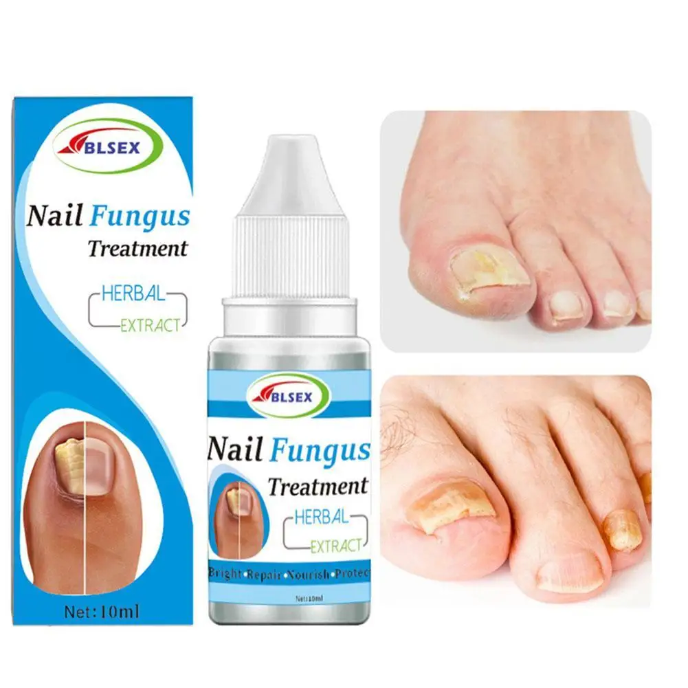 

10 мл Лечение грибка ногтей жидкость для ногтей ремонт онихомикоза паронихия против инфекции ногтей средство для удаления грибков