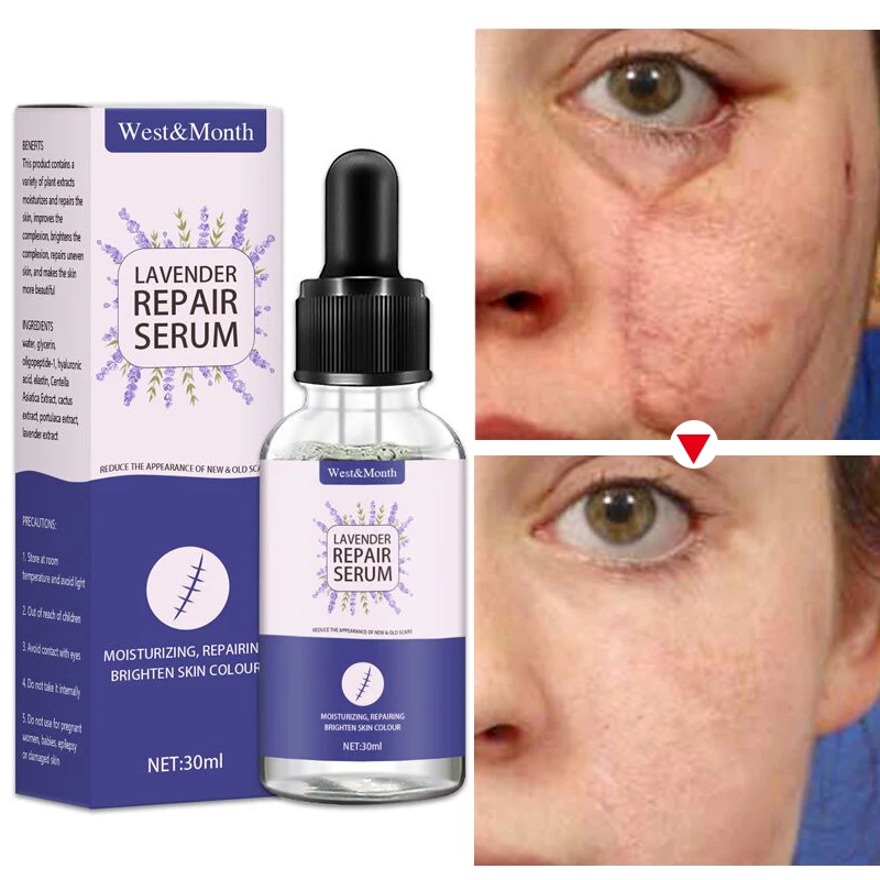 Lavender Acne Scar Removal Serum Cream Pimples Stretch Marks Treatment Pigmentation Corrector Smoothing Whitening Body Skin Care
Lavender Acne Scar Removal Serum Cream Pimples Stretch Marks Treatment Pigmentation Corrector Smoothing Whitening Body Skin Care