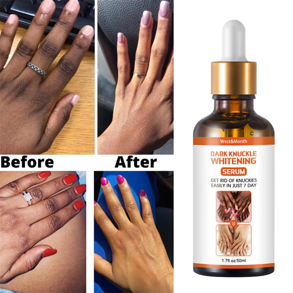 Dark Knuckle Whitening Serum Improve Dullness Even Skin Tone Joints Elbows Knees Whitening Serum for Dark Knuckle Fingel 50ml
Dark Knuckle Whitening Serum Improve Dullness Even Skin Tone Joints Elbows Knees Whitening Serum for Dark Knuckle Fingel 50ml