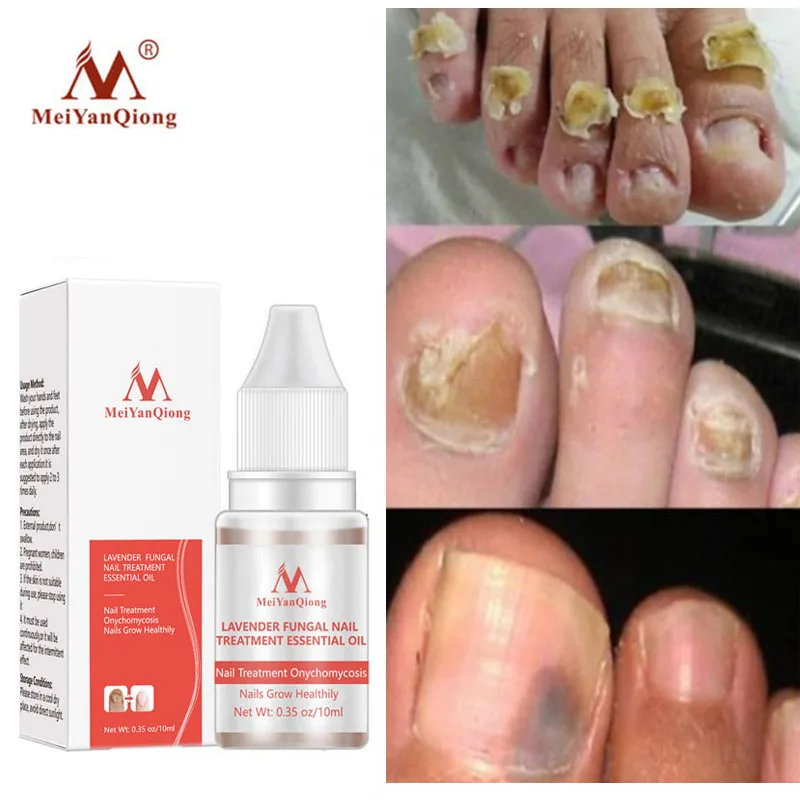 Nail Repair Serum Nail Fungal Treatment Serum Onychomycosis Paronychia Anti-Fungal Nail Infection Toe Fungus Foot Repair Care
Nail Repair Serum Nail Fungal Treatment Serum Onychomycosis Paronychia Anti-Fungal Nail Infection Toe Fungus Foot Repair Care