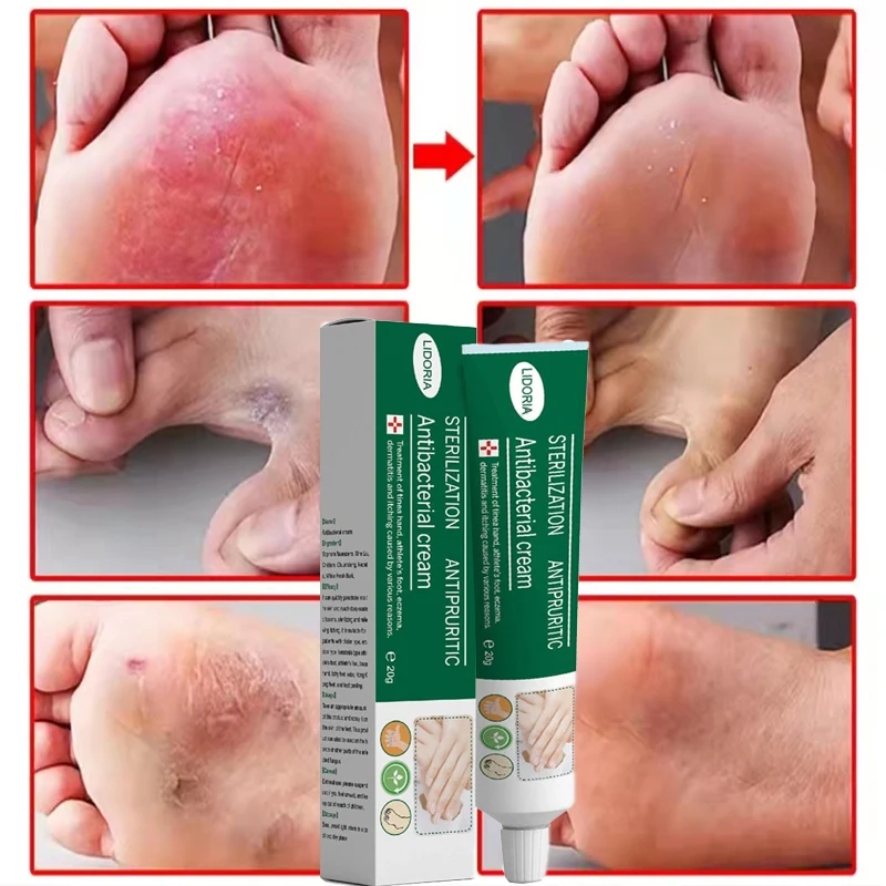 Антибактериальный крем для удаления грибка на ногах и руке, 20 г
Антибактериальный крем для удаления грибка на ногах и руке, 20 г