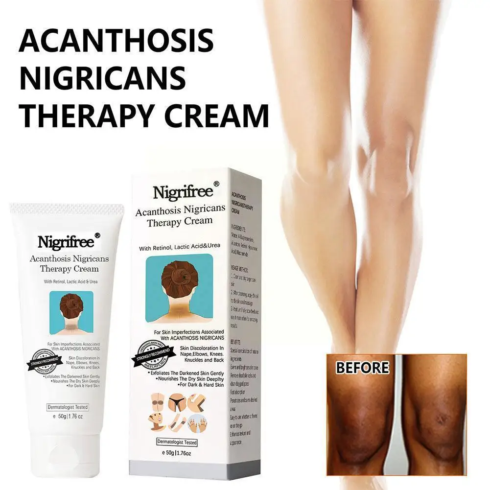 50 г Acanthosis Nigricans фотоэпиляция шеи отбеливающие детали голеностопа Темный крем для тела гиперпигментация X5Z3
50 г Acanthosis Nigricans фотоэпиляция шеи отбеливающие детали голеностопа Темный крем для тела гиперпигментация X5Z3
