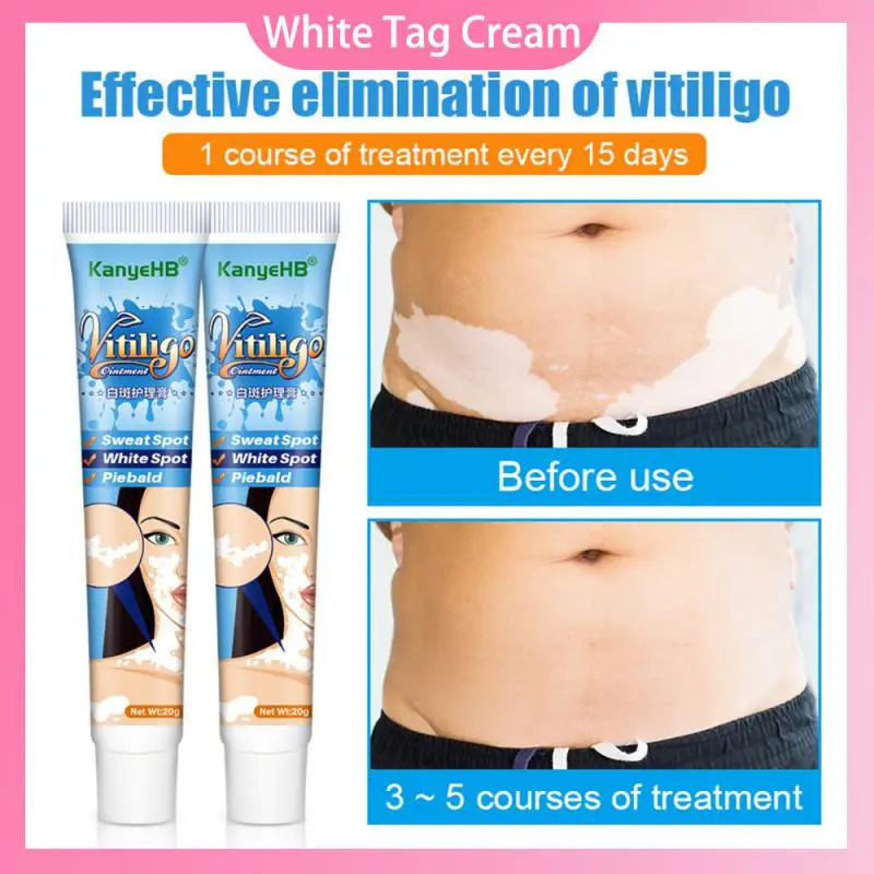 KanyeHB White Tag Cream Treatments Repair Moisturizing Cream Reduces White Spots Fades Skin Marks Skin Vitiligo Care For Adults
KanyeHB White Tag Cream Treatments Repair Moisturizing Cream Reduces White Spots Fades Skin Marks Skin Vitiligo Care For Adults