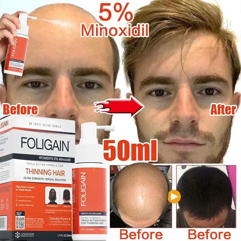 Hair essence spray anti hair loss product effective rapid growth essence anti dry scalp injury repair treatment
Hair essence spray anti hair loss product effective rapid growth essence anti dry scalp injury repair treatment
