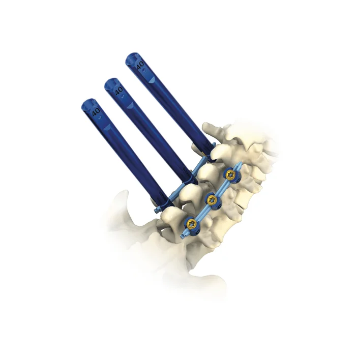Medical Spine Titanium Orthopedic Implants Price Minimally Pedicle Screw MIS Spine Surgical Pedicle Screw
Medical Spine Titanium Orthopedic Implants Price Minimally Pedicle Screw MIS Spine Surgical Pedicle Screw