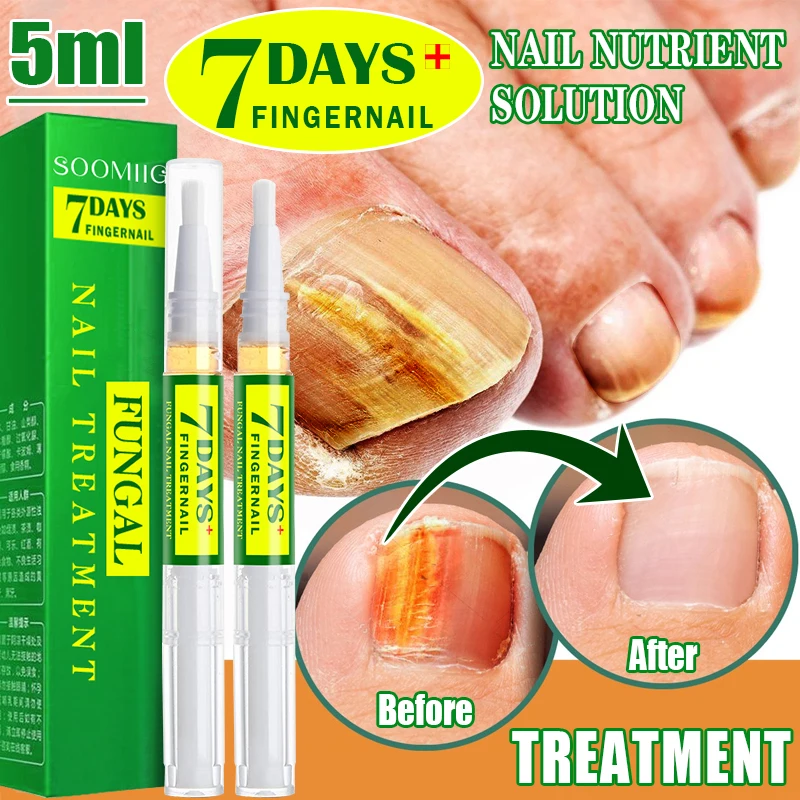 7Days Nail Fungus Repair Liquid Pen Onychomycosis Paronychia Anti-Infection Toe Hand Foot Removal Repair Gel Nail Fungus Serum
7Days Nail Fungus Repair Liquid Pen Onychomycosis Paronychia Anti-Infection Toe Hand Foot Removal Repair Gel Nail Fungus Serum