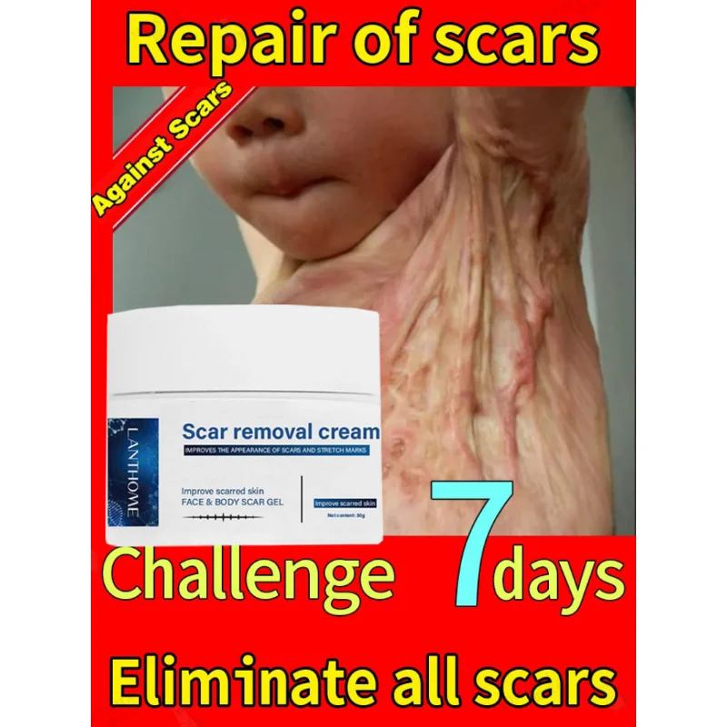 Эффективное лечение, крем для удаления шрамов, удаление рубцов при кесареве, растяжки, хирургические рубцы, сжигание ожогов, гель для ремонта шрамов
Эффективное лечение, крем для удаления шрамов, удаление рубцов при кесареве, растяжки, хирургические рубцы, сжигание ожогов, гель для ремонта шрамов