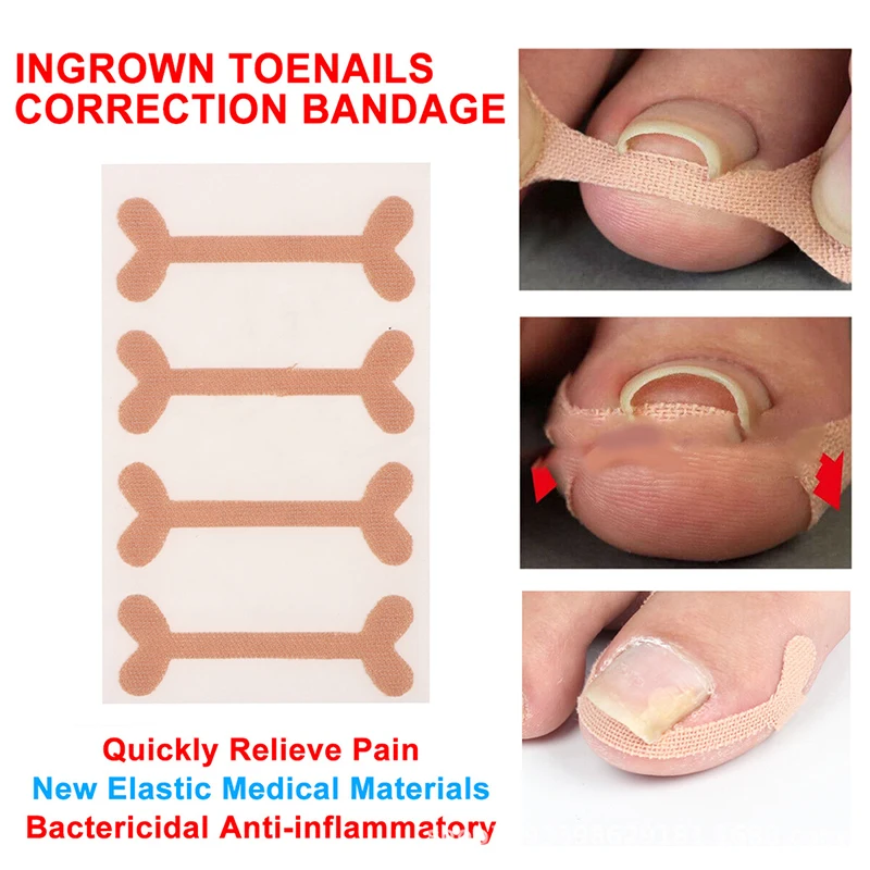 Professional Ingrown Toenail Toe Fixer Recover Correction Device Protector Tool Pedicure Foot Nail Care
Professional Ingrown Toenail Toe Fixer Recover Correction Device Protector Tool Pedicure Foot Nail Care