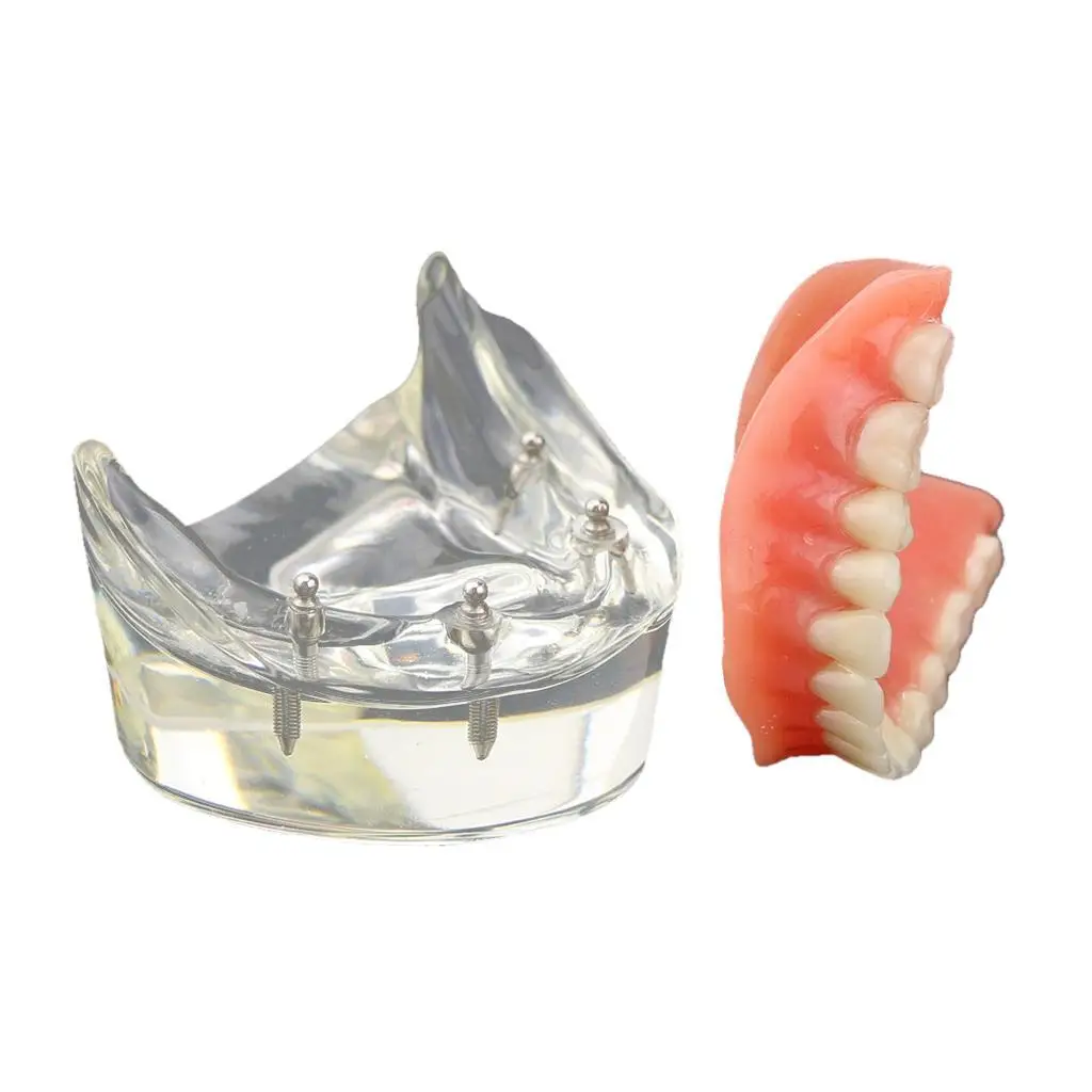 Dental Teeth Study Teach Model Overdenture Inferior 4 Implant Demo Model
Dental Teeth Study Teach Model Overdenture Inferior 4 Implant Demo Model