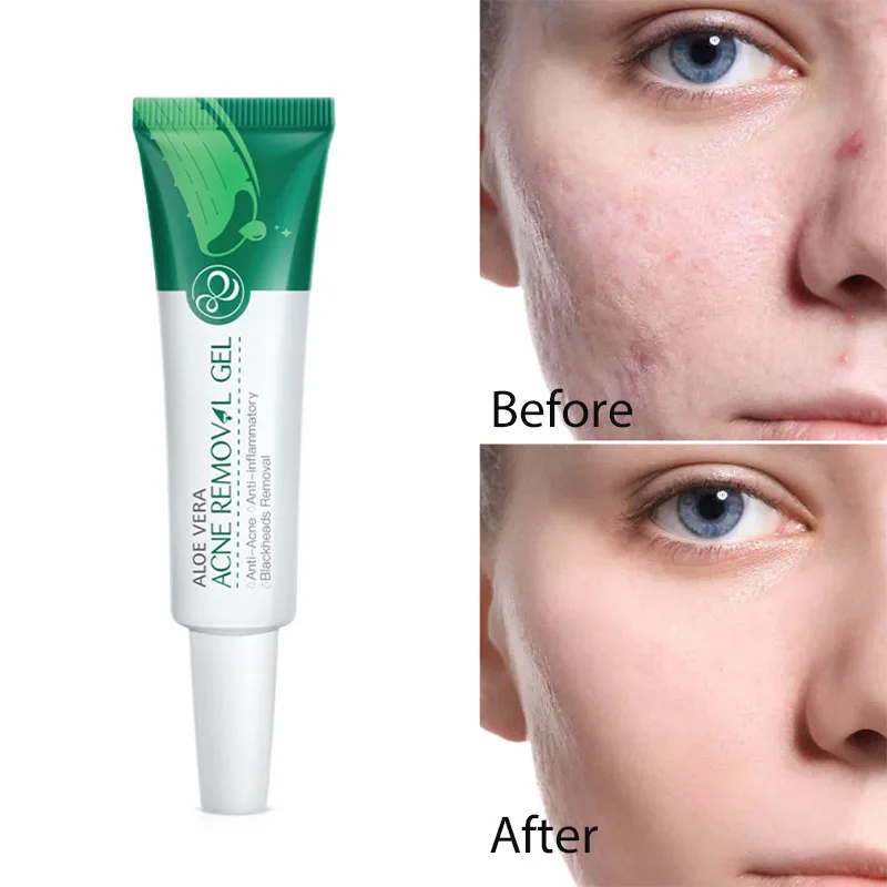 Aloe Vera Gel 100 Natural Acne Scar Removal Cream Serum Protetor Solar Facial Para Rostro Crema Blanqueadora Removedor De Cravo
Aloe Vera Gel 100 Natural Acne Scar Removal Cream Serum Protetor Solar Facial Para Rostro Crema Blanqueadora Removedor De Cravo