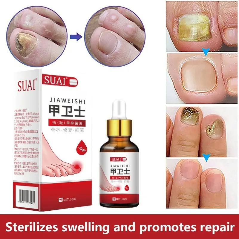 Fungal Nail Repair Essence Serum Care Treatment Foot Nail Fungus Removal Gel Anti Infection Paronychia Onychomycosis
Fungal Nail Repair Essence Serum Care Treatment Foot Nail Fungus Removal Gel Anti Infection Paronychia Onychomycosis
