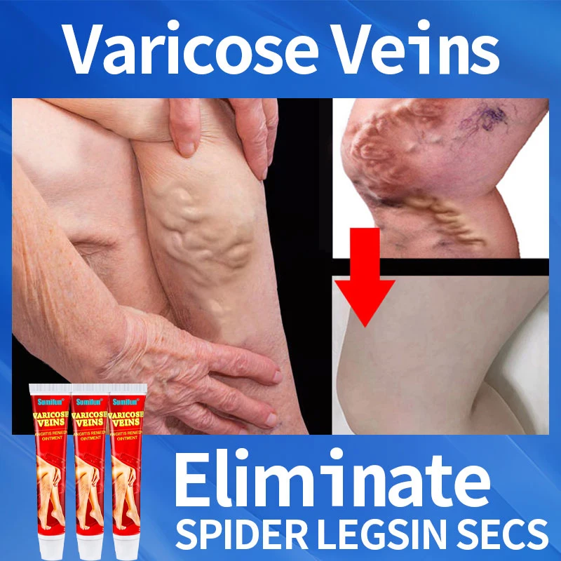 Effective Varicose Vein Relief Cream Ointment For Varicose Veins To Relieve Vasculitis Phlebitis Spider Pain Treatment
Effective Varicose Vein Relief Cream Ointment For Varicose Veins To Relieve Vasculitis Phlebitis Spider Pain Treatment