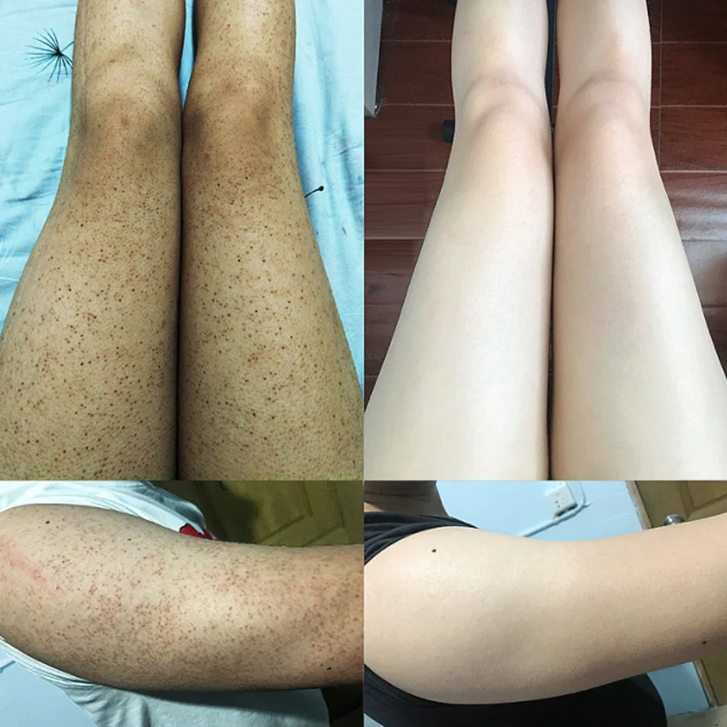 3 in 1 Salicylic Acid Repair Cream Elimination of Aging Angle Whitening Remove Dark Spots Melanin Melasma Remover Brighten Skin
3 in 1 Salicylic Acid Repair Cream Elimination of Aging Angle Whitening Remove Dark Spots Melanin Melasma Remover Brighten Skin