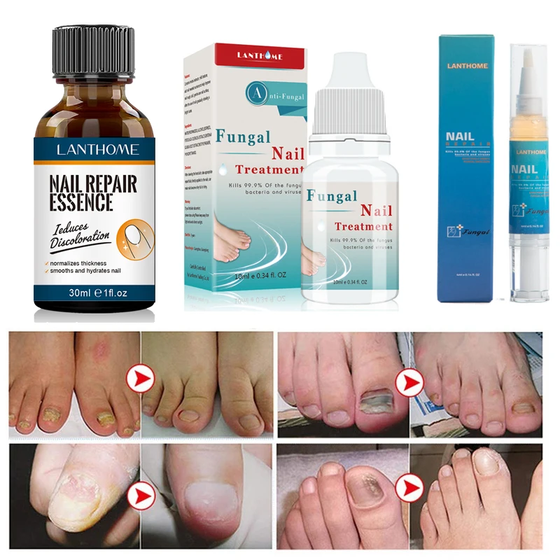 Nail Fungus Treatment Essence Nail Pen Serum Care Hand and Foot Care Removal Repair Gel Anti-infective Gel Products
Nail Fungus Treatment Essence Nail Pen Serum Care Hand and Foot Care Removal Repair Gel Anti-infective Gel Products