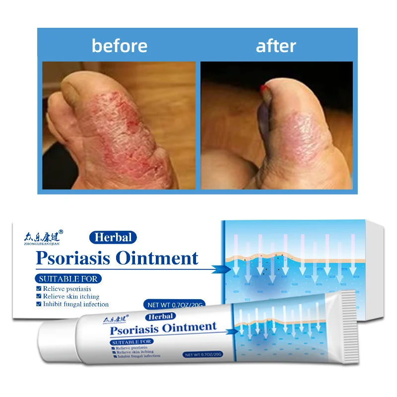 Against Psoriasis Cream Herbal Ointment Antibacterial Gel Anti-itch Relief Eczema Rash Urticaria Body Skin Care Treatment 20g
Against Psoriasis Cream Herbal Ointment Antibacterial Gel Anti-itch Relief Eczema Rash Urticaria Body Skin Care Treatment 20g