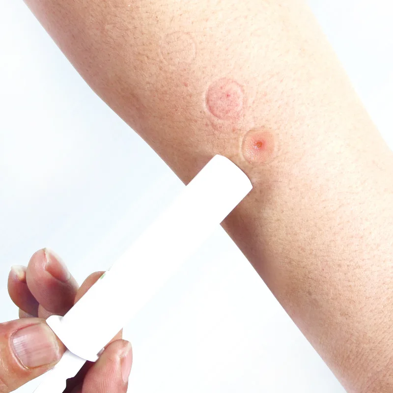 Mosquito Bites The Drug Holder Vacuum Pull Poison System Outdoor Picnic Camping Climbing
Mosquito Bites The Drug Holder Vacuum Pull Poison System Outdoor Picnic Camping Climbing