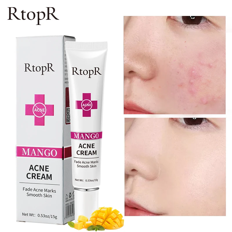 RtopR Mango Acne Cream Fades acne marks on the face Smooth Moisturized skin Clean skin Facial skin care Whitening Day cream
RtopR Mango Acne Cream Fades acne marks on the face Smooth Moisturized skin Clean skin Facial skin care Whitening Day cream