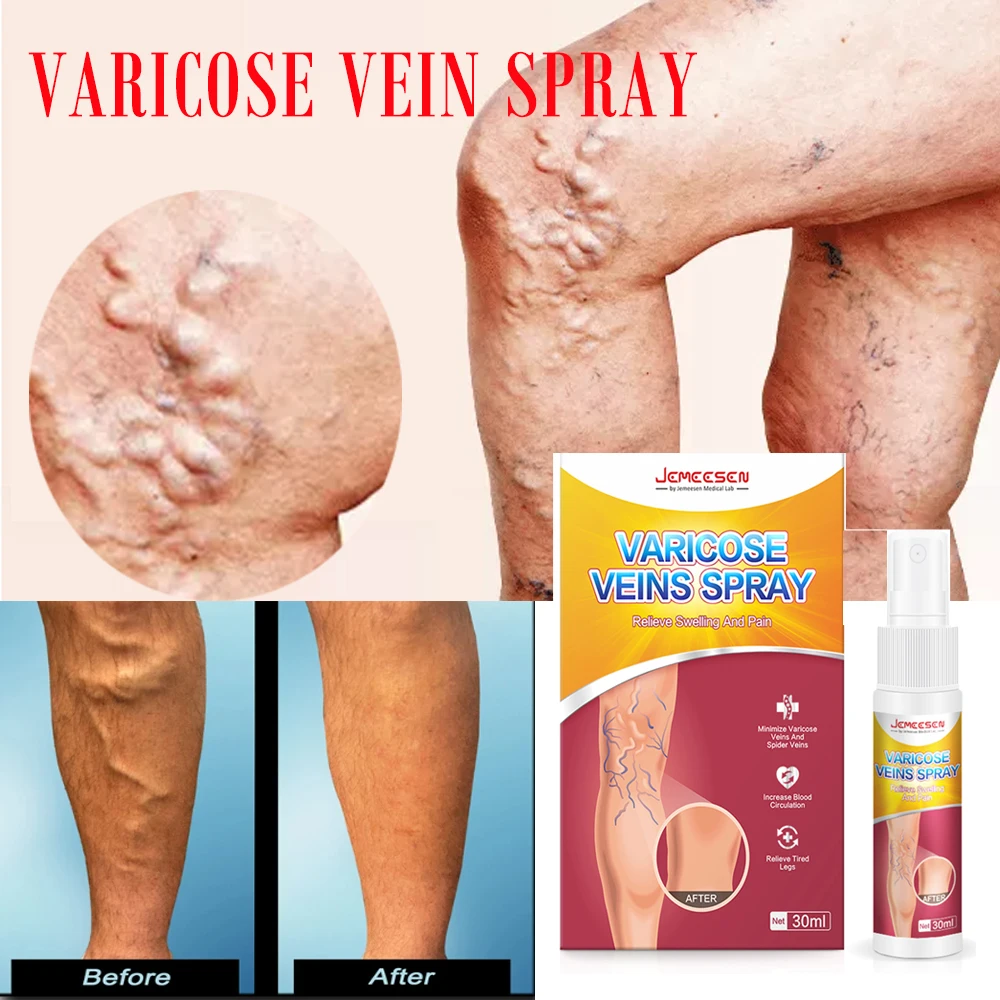 Jemeesen Varicose Veins Effective Remover Pain Relieving Spray Varicose Vein Plaster Patch Cream Essence
Jemeesen Varicose Veins Effective Remover Pain Relieving Spray Varicose Vein Plaster Patch Cream Essence