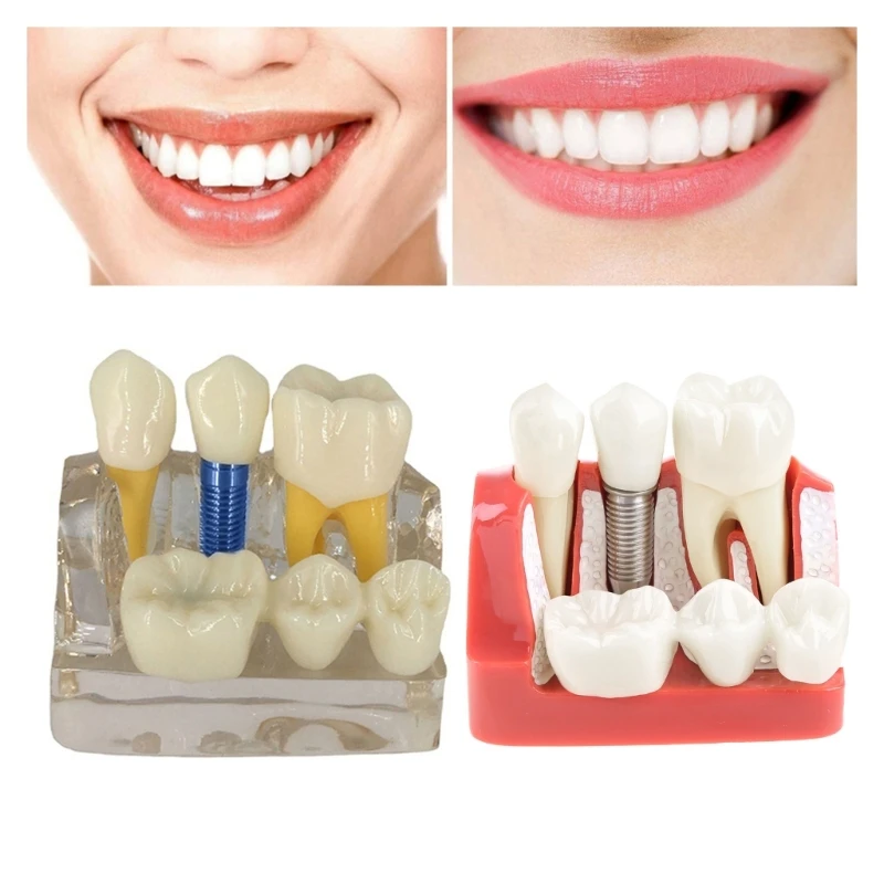 Модель зубов 4 раза, модель зубов, стоматологический имплантат, корончатый мост
Модель зубов 4 раза, модель зубов, стоматологический имплантат, корончатый мост