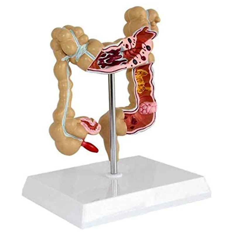 Colon Pathological Colorectal Cancer Model Large Intestine Model Gastrointestinal Anatomical Model
Colon Pathological Colorectal Cancer Model Large Intestine Model Gastrointestinal Anatomical Model