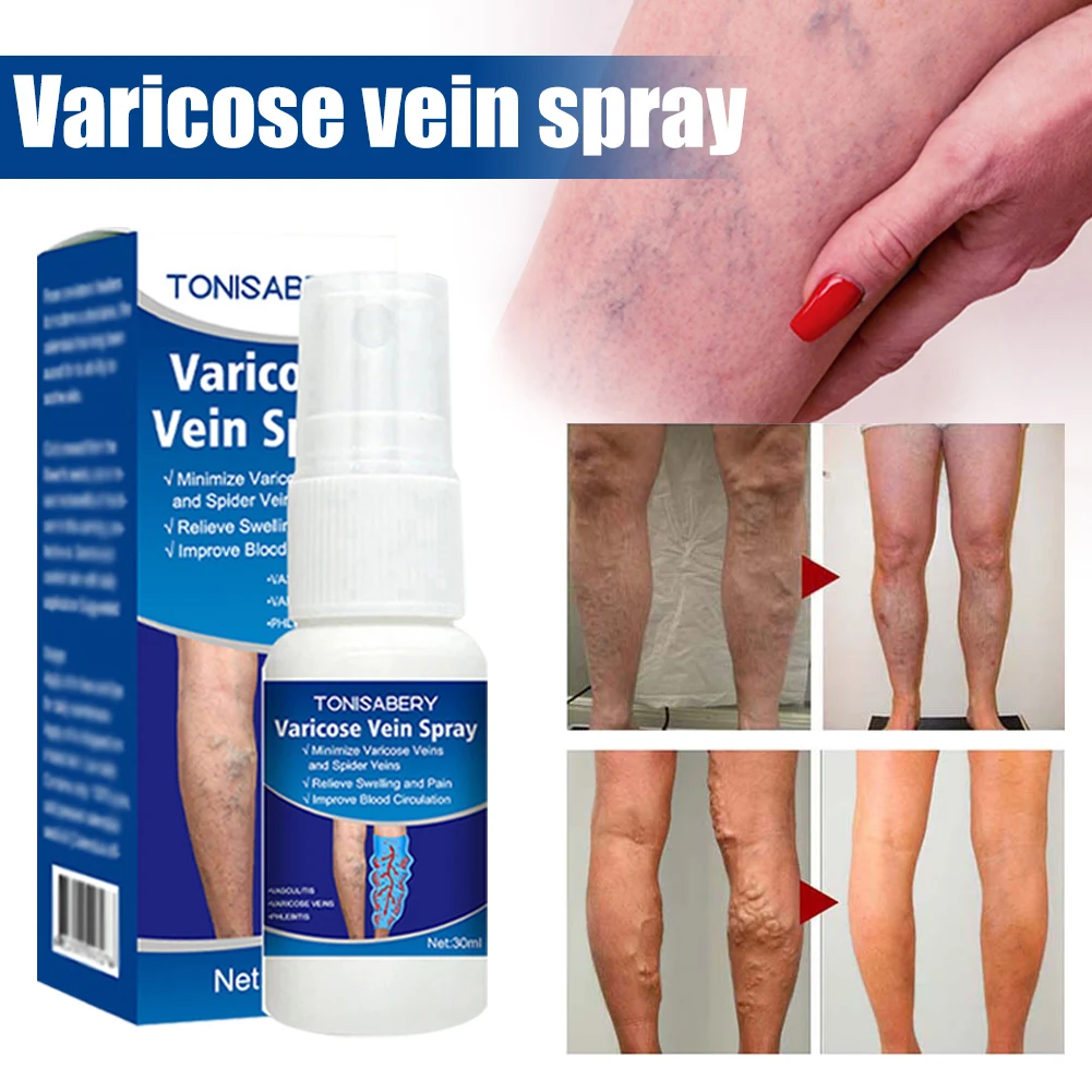 Varicose Vein Spray Effective Vasculitis Phlebitis Spider Legs Soothing Spray Blood Vessel Bulging Pain Relief Healthy Body Care
Varicose Vein Spray Effective Vasculitis Phlebitis Spider Legs Soothing Spray Blood Vessel Bulging Pain Relief Healthy Body Care