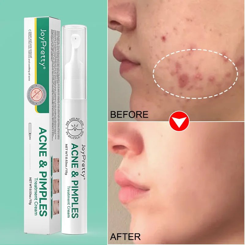 Acne Removal Whitening Cream Effective Fade Acne Spots Repair Oil Control Moisturizing Shrink Pores Acne Treatment Skin Care
Acne Removal Whitening Cream Effective Fade Acne Spots Repair Oil Control Moisturizing Shrink Pores Acne Treatment Skin Care