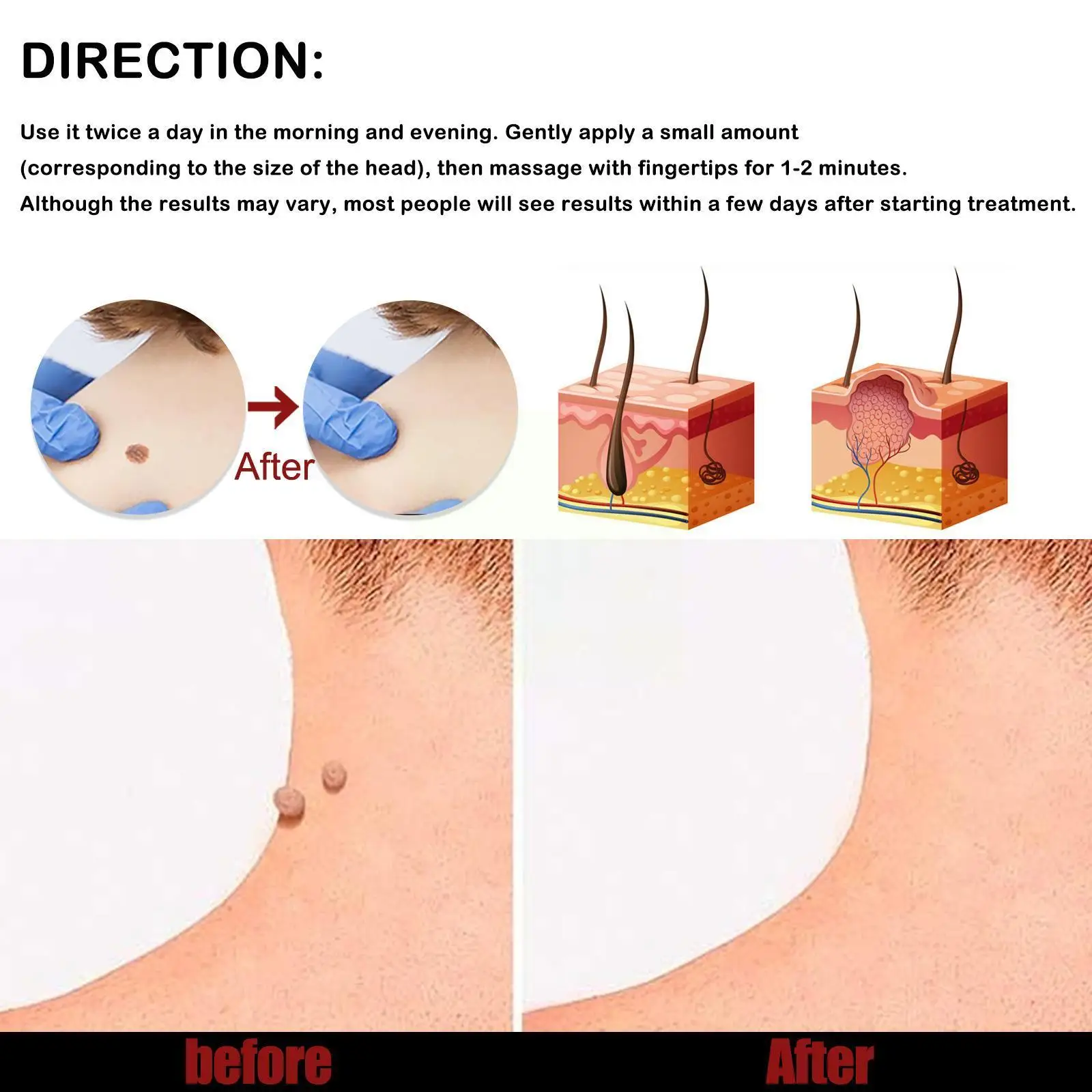Skin Tag Remover Cream Painless Mole Skin Dark Spot Remover Treatment Cream Wart Serum Face Freckle Warts Essential Tag Rem V0X3
Skin Tag Remover Cream Painless Mole Skin Dark Spot Remover Treatment Cream Wart Serum Face Freckle Warts Essential Tag Rem V0X3