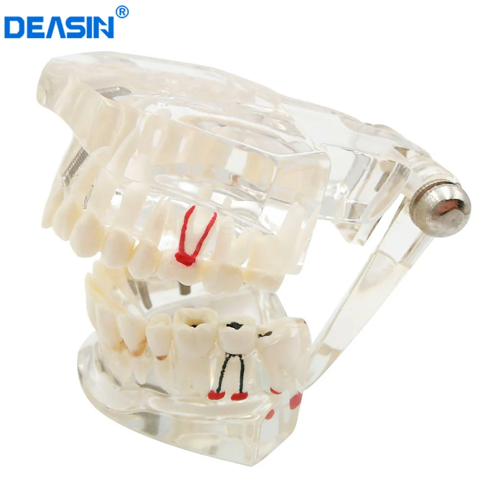 Новая модель зубного импланта с реставрационным мостом, зубной протез для медицинских целей, обучение стоматологическим заболеваниям 
Новая модель зубного импланта с реставрационным мостом, зубной протез для медицинских целей, обучение стоматологическим заболеваниям