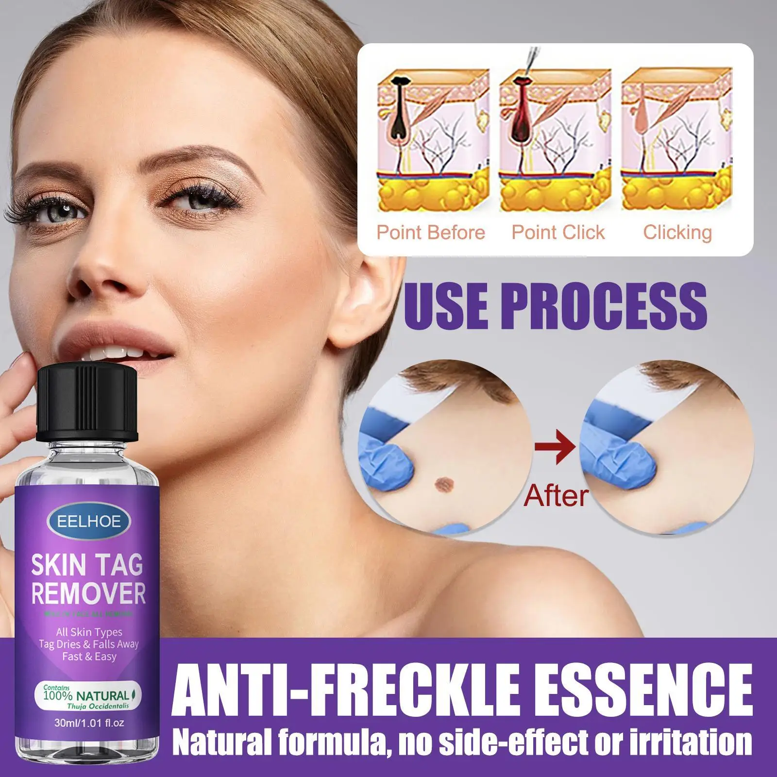 10/30ml Skin Tag Remover Medical Fast Wart Removal Acne Spot Treatment Anti Foot Corn Lotion Body Care Wart Remover
10/30ml Skin Tag Remover Medical Fast Wart Removal Acne Spot Treatment Anti Foot Corn Lotion Body Care Wart Remover