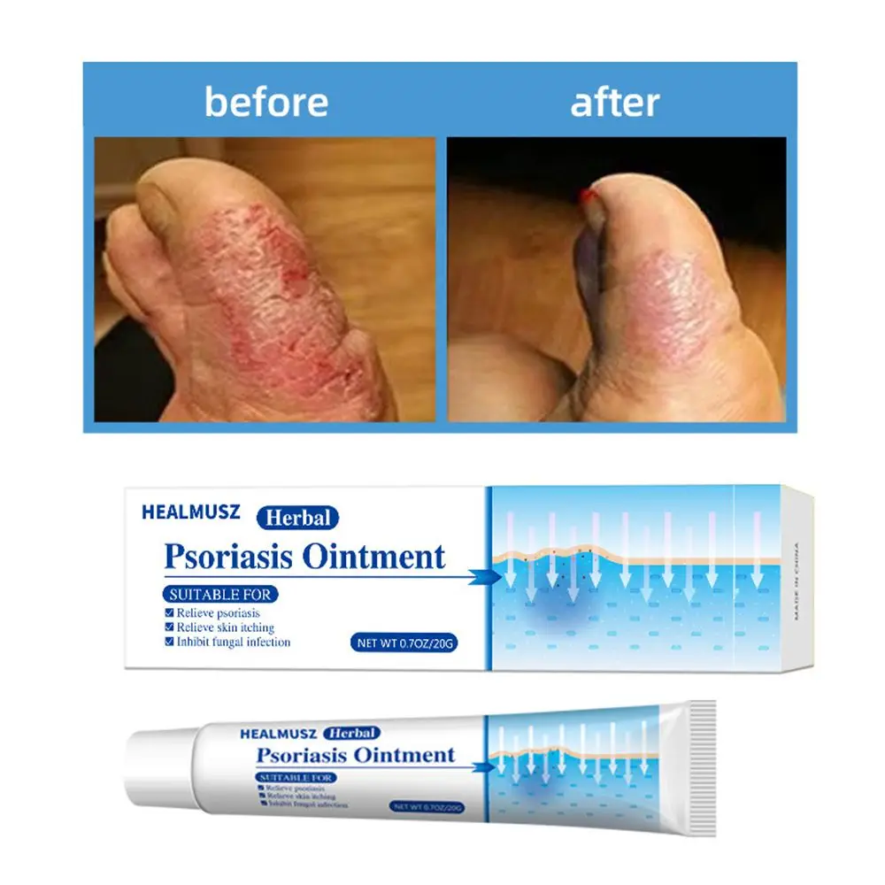 Body Health Skin Care Eczema Rash Urticaria Desquamation Anti-itch Relief Antibacterial Cream Psoriasis Ointment
Body Health Skin Care Eczema Rash Urticaria Desquamation Anti-itch Relief Antibacterial Cream Psoriasis Ointment