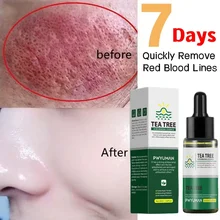 Rosacea Treatment Snail Essence Lotion Repair Facial Redness Dry Sensitive Skin Intense Moisturizer Sooth Korean Care Cosmetics