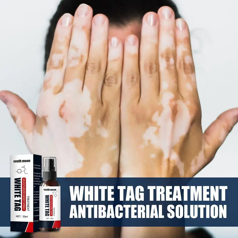 New White Spot Remover Spray 30g Herbal Antibacterial Disease Care Vitiligo Face Serum Body Leukoplakia Treatment Repair U2c9
New White Spot Remover Spray 30g Herbal Antibacterial Disease Care Vitiligo Face Serum Body Leukoplakia Treatment Repair U2c9