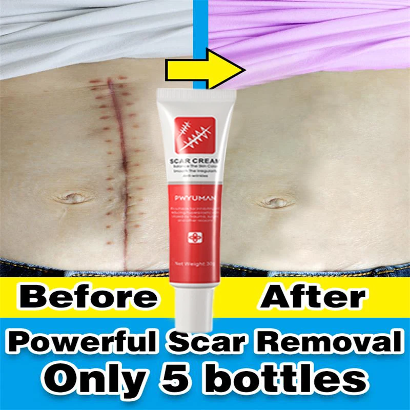 Scar Removal Cream Remove Stretch Marks Burn Keloid Treat Surgery Scars Remove Acne Spot Gel Smooth Skin Whitening Care Products 
Scar Removal Cream Remove Stretch Marks Burn Keloid Treat Surgery Scars Remove Acne Spot Gel Smooth Skin Whitening Care Products