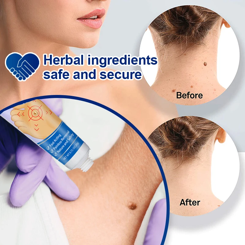 Warts Remover Herbal Antibacterial Ointment Wart Treatment Cream Remove Skin Tag Anti Foot Corn Papillomas Rapidly Removal Gel
Warts Remover Herbal Antibacterial Ointment Wart Treatment Cream Remove Skin Tag Anti Foot Corn Papillomas Rapidly Removal Gel