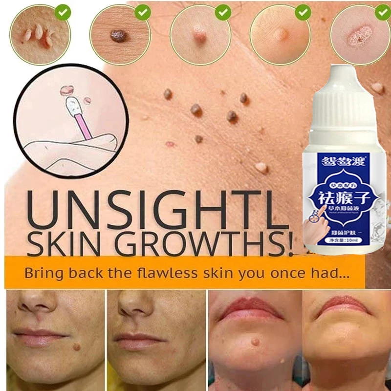 1pcs Skin Tag Remover Genital Wart Treatment Instant Removal Mole&Papillomas Foot Corn Repair Tool Natural Bacteriostatic Liquid
1pcs Skin Tag Remover Genital Wart Treatment Instant Removal Mole&Papillomas Foot Corn Repair Tool Natural Bacteriostatic Liquid