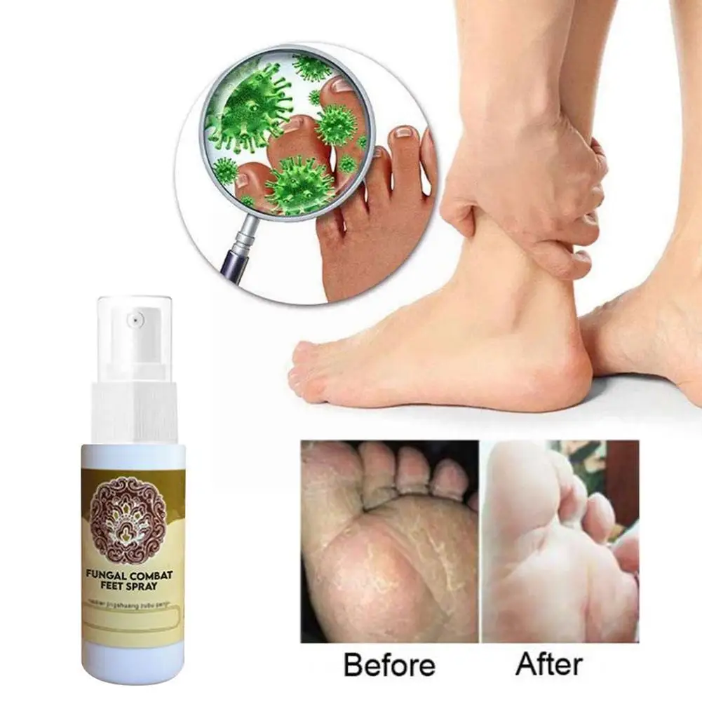 Fungal Combat Feet Spray Foot Sterilize Spray Herbal Treatment Anti-fungal Infection Anti Bacterial Toe Onychomycosis O9r7
Fungal Combat Feet Spray Foot Sterilize Spray Herbal Treatment Anti-fungal Infection Anti Bacterial Toe Onychomycosis O9r7