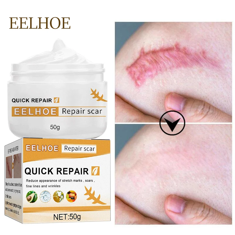 Effective Scar Removal Cream Repairing Surgical Scar Cesarean Scar Stretch Marks Treatment Whitening Moisturizing Body Skin Care 
Effective Scar Removal Cream Repairing Surgical Scar Cesarean Scar Stretch Marks Treatment Whitening Moisturizing Body Skin Care