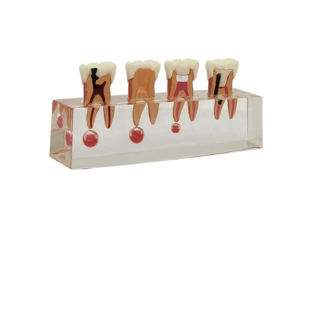 Dental Typodont Teeth Model 4 Stage Endodontic Treatment Study Demonstrate Model dental odontología dental orthodontic
Dental Typodont Teeth Model 4 Stage Endodontic Treatment Study Demonstrate Model dental odontología dental orthodontic