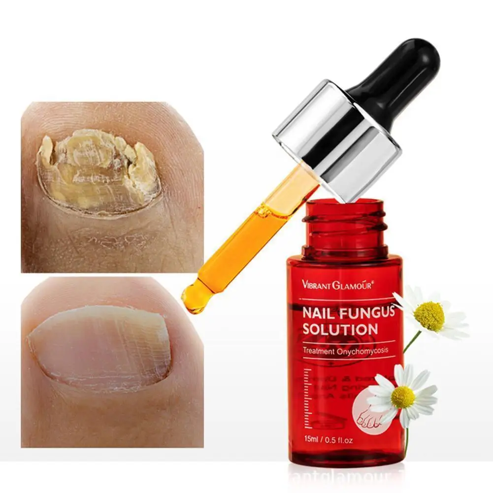 15ml Onychomycosis Care Serum Treatment Removal Of Fungal Paronychia Anti Nail Infection Toe Nail Fungus Oil Ony Chomycosis
15ml Onychomycosis Care Serum Treatment Removal Of Fungal Paronychia Anti Nail Infection Toe Nail Fungus Oil Ony Chomycosis