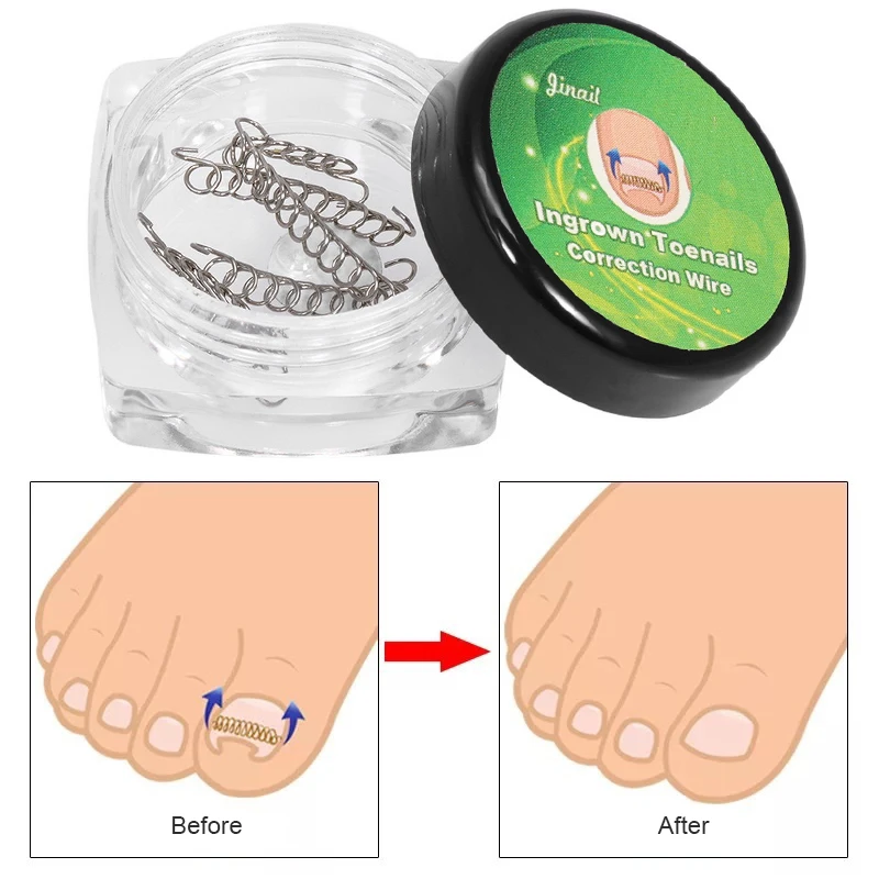 1 Box Ingrown Toe Nail Correction Wire Fixer Pedicure Paronychia Recover Toenails Corrector Correction Stickers Foot Care Tool
1 Box Ingrown Toe Nail Correction Wire Fixer Pedicure Paronychia Recover Toenails Corrector Correction Stickers Foot Care Tool